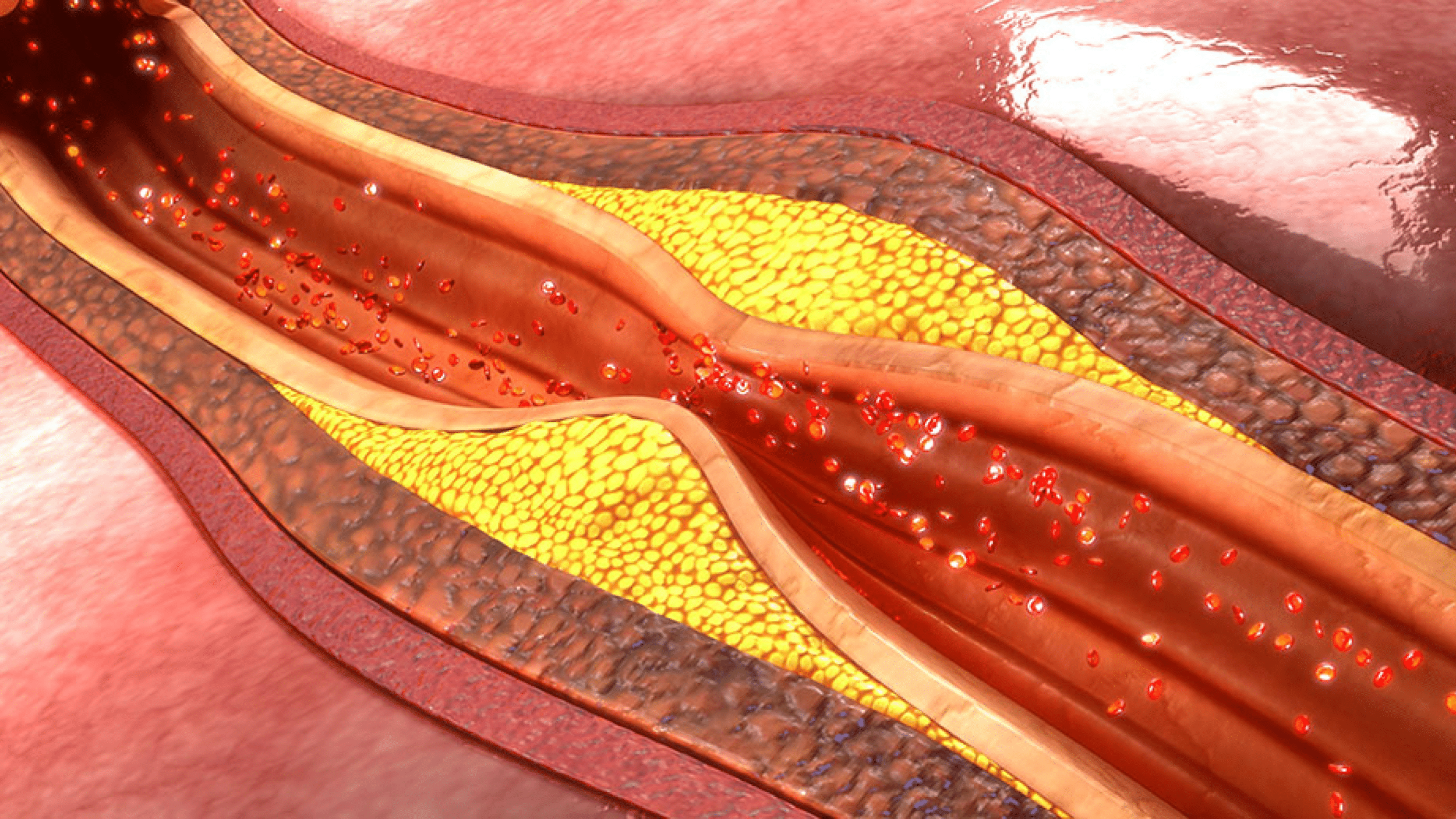 Nano-Immunotherapy Offers New Possibilities in Treating Atherosclerosis